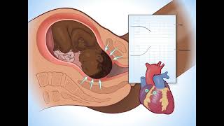 Early Decelerations  Fundamentals of Fetal Health Surveillance [upl. by Irmgard]