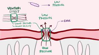 Endocarditis infective libman sacks causes symptoms treatment amp pathology [upl. by Cadmar202]