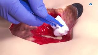 How to Effectively Cleanse and Debride a Wound  Wound Cleansing and Debridement  Ausmed Education [upl. by Randell]