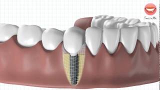 Vidéo de démonstration pour une pose dimplant dentaire [upl. by Airrej424]