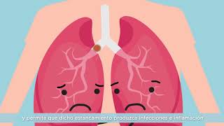 Vídeo 1  ¿Qué es la Fibrosis Quística [upl. by Bevon]