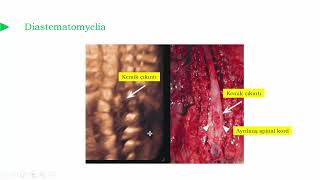 Diastematomyelia [upl. by Aila324]