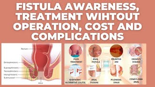 Fistula awareness Treatment without operation cost and complications Dr Mohamad Ahamad [upl. by Ayam]