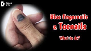 Bluish discoloration of nails What does it mean Dr Rajdeep Mysore [upl. by Stuckey]