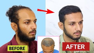 5 Month amazing hair transplant results  100 Natural hair  best hair transplant in india 2024 [upl. by Tillfourd]