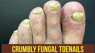 SUPER SATISFYING FUNGAL TOENAIL CLEANING BRING THE PILLOWS [upl. by Ecyt836]