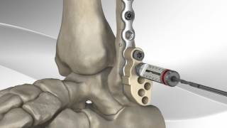 Enkel fractuur operatieve behandeling fibula [upl. by Alberta682]