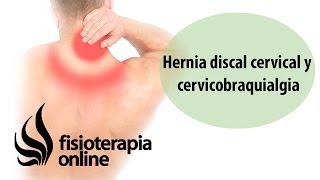 Hernia discal cervical y cérvicobraquialgia [upl. by Onibla283]