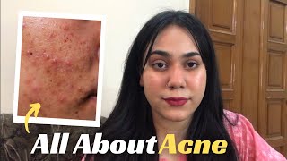 All About Acne  Remove Acne  Shamaim Rajpoot [upl. by Eseerahs]