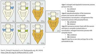 Castellvi classification of lumbosacral transitional vertebrae [upl. by Nahrut]