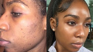 HOW I CLEARED MY ACNE amp HYPERPIGMENTATION  GLASS SKIN SKINCARE ROUTINE [upl. by Wye353]