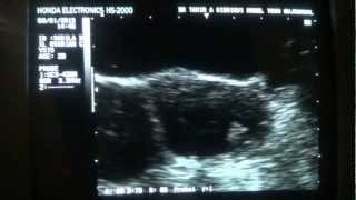 Bilateral ovarian cysts ultrasound study [upl. by Kcirded168]