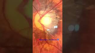 Myopic Fundus  Fundus Photography  Myopic Crescent  Short Video 161 viral optometryacademy [upl. by Leong784]