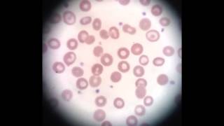 Under the Microscope  Sickle Cell Anemia [upl. by Thorma401]