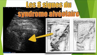 8 aspects de pneumopathie en échographie [upl. by Mccreary63]