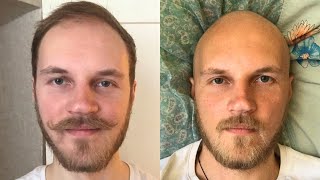 BALDING IN MY 20s Full Head Shave Transformation [upl. by Bolling]