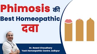 Best Homeopathic Medicine for Phimosis  Phimosis का बिना ऑपरेशन के इलाज Best Treatment of Phimosis [upl. by Lienet]