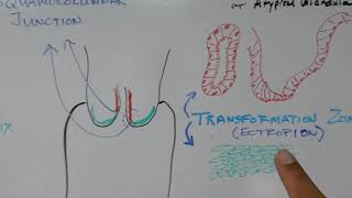 UTERINE CERVIX PATHOLOGY  Atypical Endocervix amp Atypical Glandular Cells [upl. by Spike]