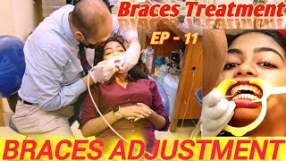 Braces Adjustment  Braces Treatment  Orthodontic Treatment  Braces  Ep11 braces orthodontic [upl. by Tavy]