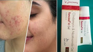 Femcinol A Gel review  Femcinol A Skin Gel  7 दिन मे फर्क पिंपल के दाग भी चले जाते है femcinol a [upl. by Nabi540]