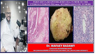 PERIVASCULAR EPITHELIOID CELL TUMOR OF THE UTERUS UTERINE PEComa BY DR WAFAEY BADAWY [upl. by Sarina518]