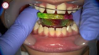 step by step Growth modification by activator in orthodontics by Dr Amr Asker [upl. by Ahusoj]