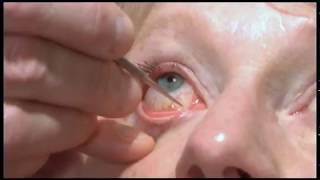 Oculoplastics basic exam Lacrimal system examination [upl. by Ehsiom]