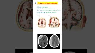 Sub Dural Haematoma Neet pg Fmge Inicet ytshort medicaleducation viralshorts [upl. by Krein927]