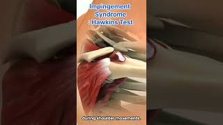 Shoulder Pain Impingement Syndrome And The Hawkins Test [upl. by Gus790]