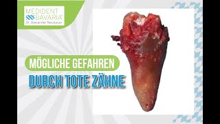 Mögliche Gefahren durch tote Zähne [upl. by Arebma]