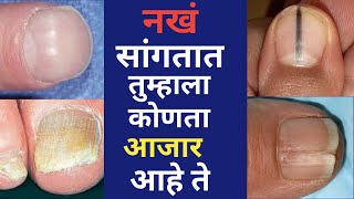 Nails and disease । नखांच्या रंगावरुन तुमचा आजार ओळखा। [upl. by Anyl]