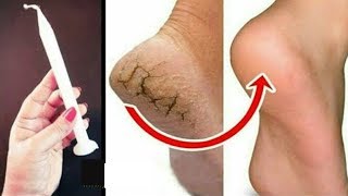 Reduce Cracked Heels Completely  Amazing Home Remedies for Cracked Heels Treatment [upl. by Noived]