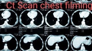 Ct scan chest plain filming  ct chest filming [upl. by Spragens693]