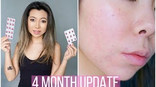 4 Month Accutane Update \ Side Effects  Quitting [upl. by Cleasta741]