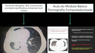 Espessamento interlobular [upl. by Grefer345]