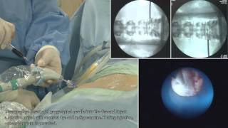 II TELA  Transforaminal Epiduroscopic Laser Annuloplasty   full procedure [upl. by Shotton]