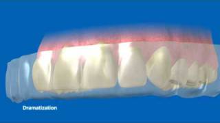 NEW Crest Whitestrips Advanced Seal  How it works [upl. by Bruner]