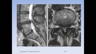 Lumbar Spinal Stenosis Cauda Equina Syndrome Sciatica amp Disc Herniation An Advanced Lecture [upl. by Duong]