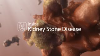 Medical Animation Kidney Stone Disease [upl. by Terena76]