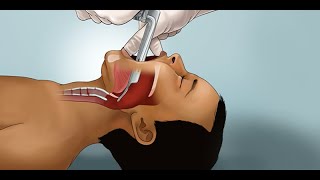 Pediatric Endotracheal Intubation by J Nagler et al  OPENPediatrics [upl. by Rasecoiluj39]