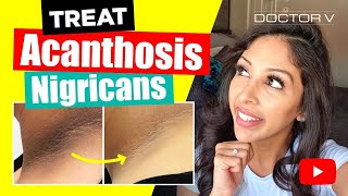 Doctor V  How To Treat Acanthosis Nigrican  Skin Of Colour  Brown Or Black Skin [upl. by Ailesor]