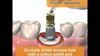 Implantes dentales secuencia completa [upl. by Melantha664]