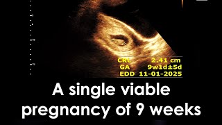 A single viable pregnancy of 9 weeks  Early pregnancy  Practical case [upl. by Lusa638]