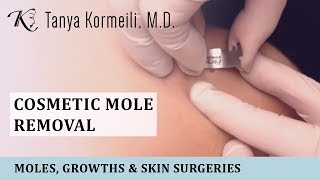 Cosmetic mole removal [upl. by Wyne]