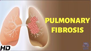 Pulmonary Fibrosis Everything You Need To Know [upl. by Retseh]