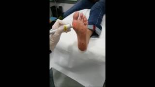 Trattamento Verruche con laser Fisioline Lumix CPS Podiatry [upl. by Ynomrah]