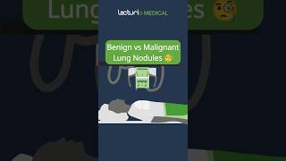 Benign vs Malignant Lung Nodules 🧐 USMLE MedicalEducation Radiology [upl. by Garin]