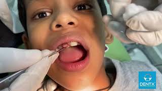 DrKiranKoora Pediatric Dentist  Operculectomy Procedure [upl. by Syned]