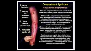 Compartment Syndrome Clinical Presentation  Everything You Need To Know  Dr Nabil Ebraheim [upl. by Illek]