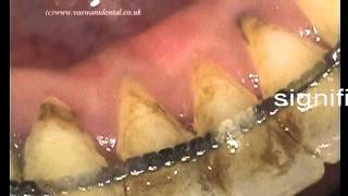 Non Surgical Periodontal Treatment [upl. by Genaro959]